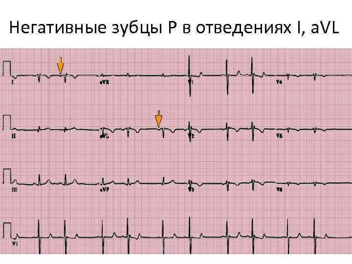 Негативные зубцы Р в отведениях I, a. VL 