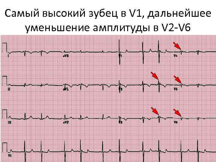 Самый высокий зубец в V 1, дальнейшее уменьшение амплитуды в V 2 -V 6