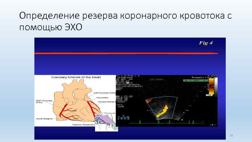 Определение резерва коронарного кровотока c помощью ЭХО 26 