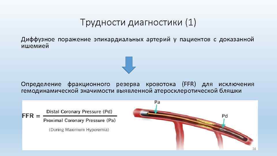 Трудности диагностики (1) Диффузное поражение эпикардиальных артерий у пациентов с доказанной ишемией Определение фракционного