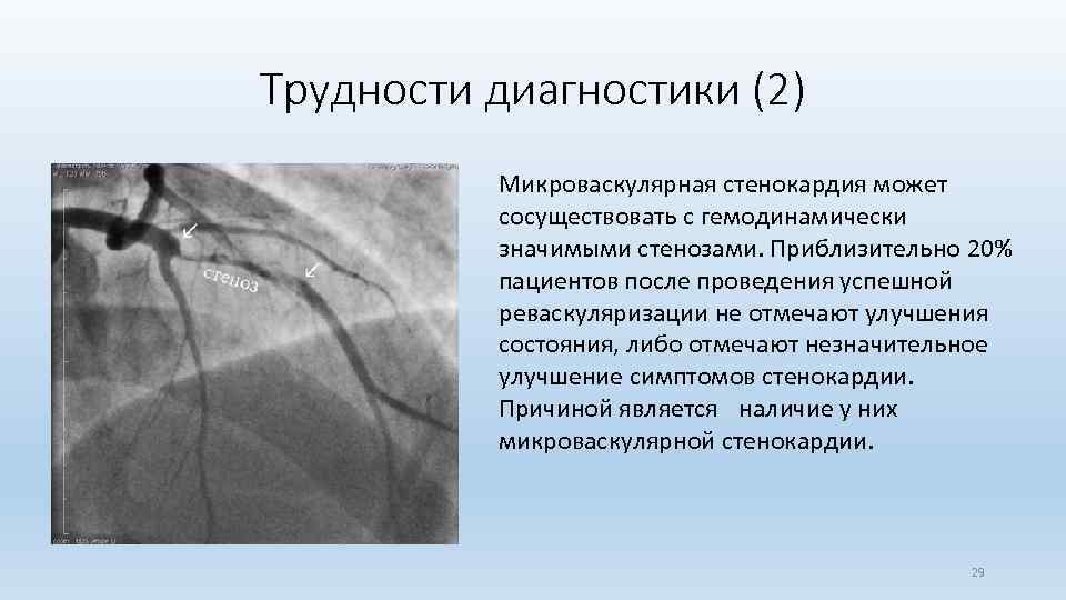 Трудности диагностики (2) Микроваскулярная стенокардия может сосуществовать с гемодинамически значимыми стенозами. Приблизительно 20% пациентов