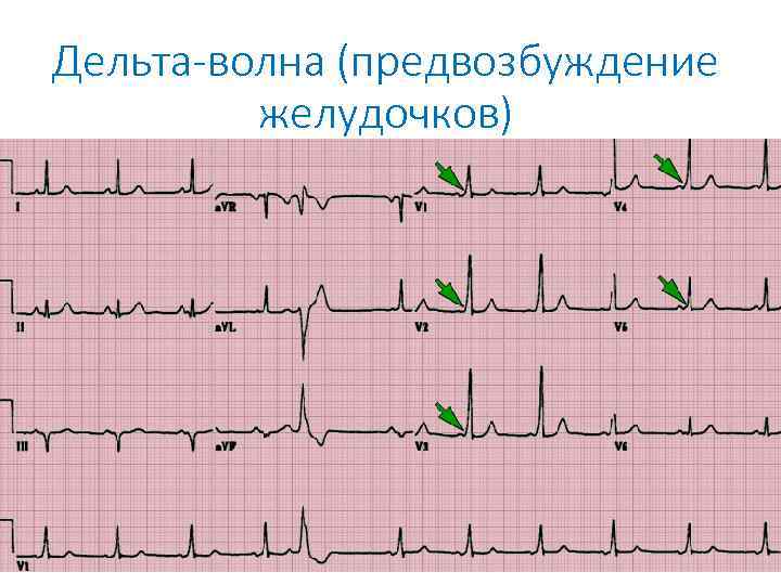 Дельта-волна (предвозбуждение желудочков) 