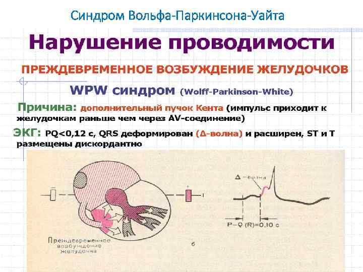 Синдром Вольфа-Паркинсона-Уайта 