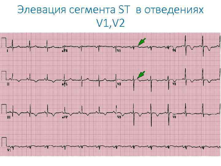 Элевация сегмента ST в отведениях V 1, V 2 