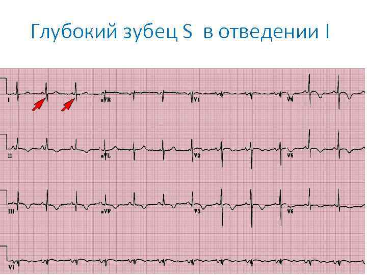 Глубокий зубец S в отведении I 