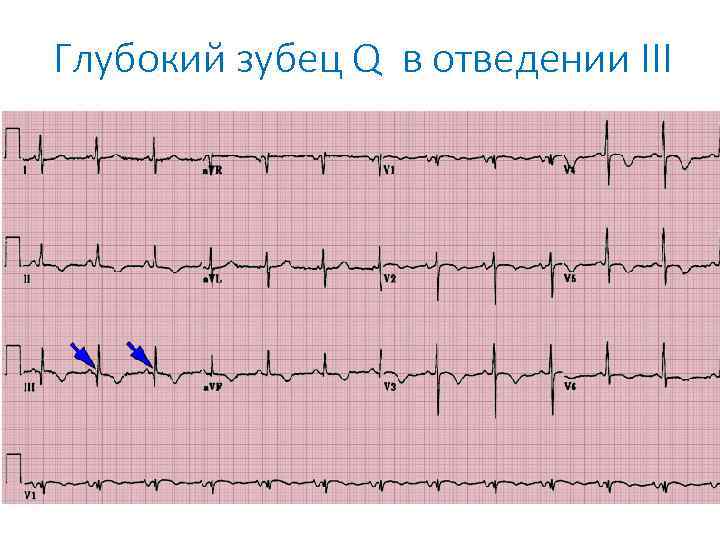 Глубокий зубец Q в отведении III 