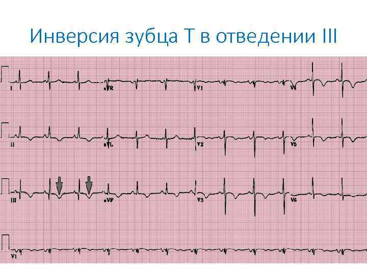 Инверсия зубца Т в отведении III 