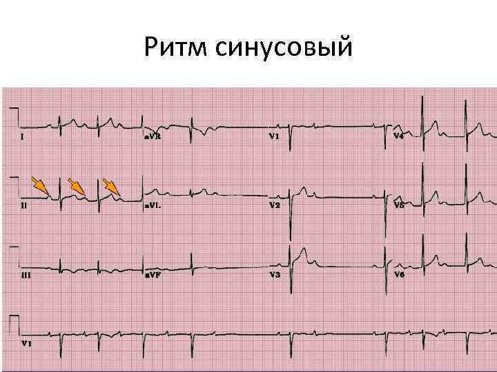 Ритм синусовый 
