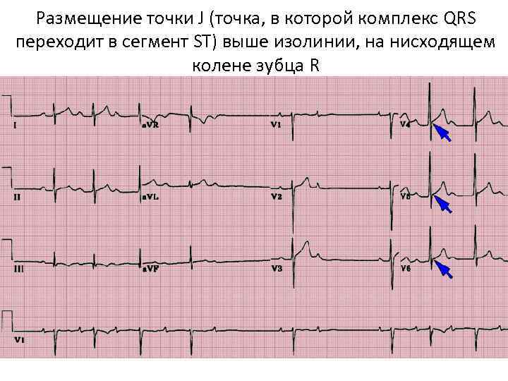Размещение точки J (точка, в которой комплекс QRS переходит в сегмент ST) выше изолинии,