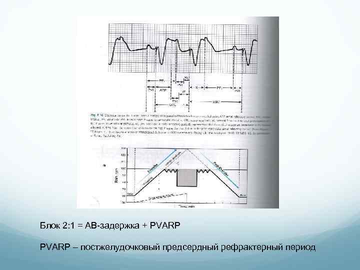 Блок 2: 1 = АВ-задержка + PVARP – постжелудочковый предсердный рефрактерный период 