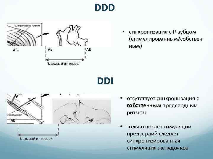 DDD АВ АВ • синхронизация с P-зубцом (стимулированным/собствен ным) АВ базовый интервал DDI •
