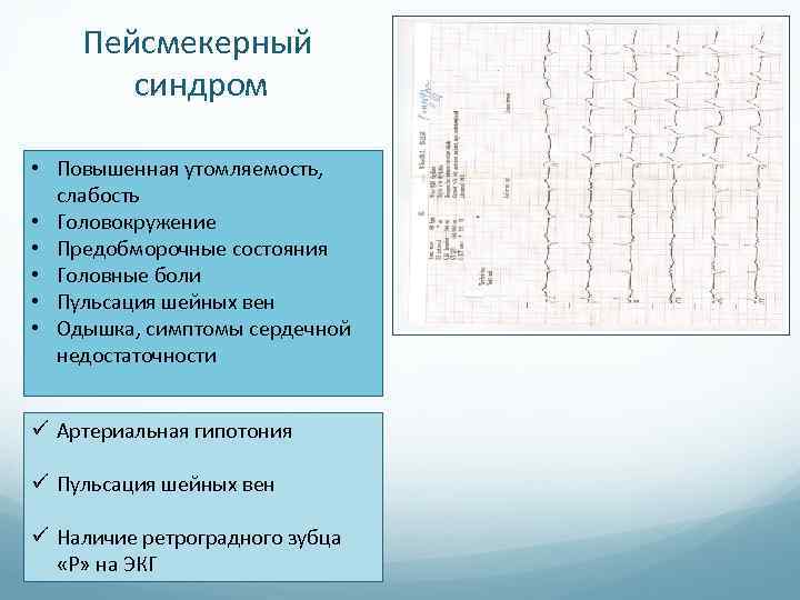 Пейсмекерный синдром • Повышенная утомляемость, слабость • Головокружение • Предобморочные состояния • Головные боли