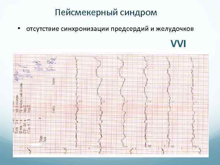 Пейсмекерный синдром • отсутствие синхронизации предсердий и желудочков VVI 