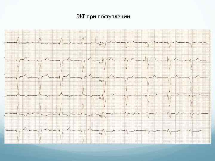 ЭКГ при поступлении 