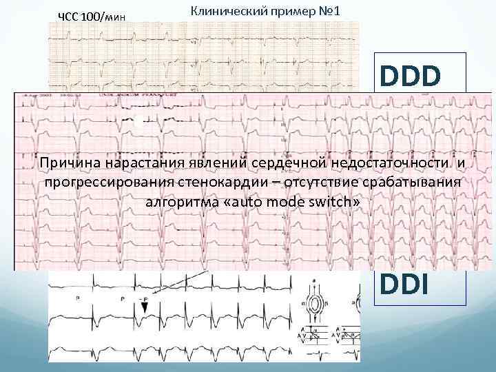 ЧСС 100/мин Клинический пример № 1 DDD Причина нарастания явлений сердечной недостаточности и прогрессирования
