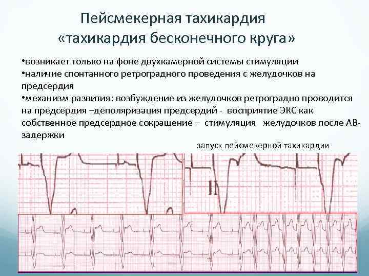  Пейсмекерная тахикардия «тахикардия бесконечного круга» • возникает только на фоне двухкамерной системы стимуляции