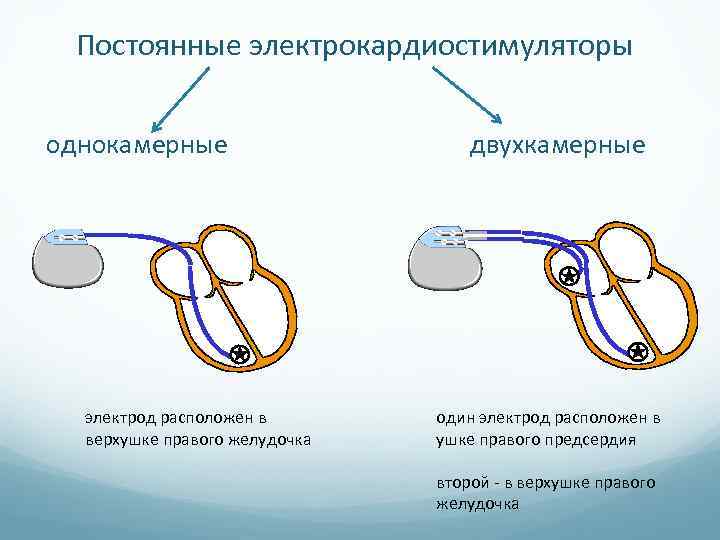 Постоянные электрокардиостимуляторы однокамерные электрод расположен в верхушке правого желудочка двухкамерные один электрод расположен в