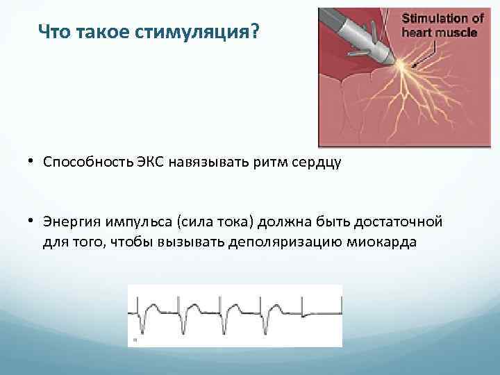 Что такое стимуляция? • Способность ЭКС навязывать ритм сердцу • Энергия импульса (сила тока)