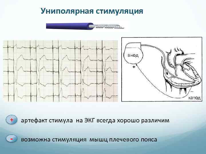 Униполярная стимуляция анод катод + артефакт стимула на ЭКГ всегда хорошо различим - возможна