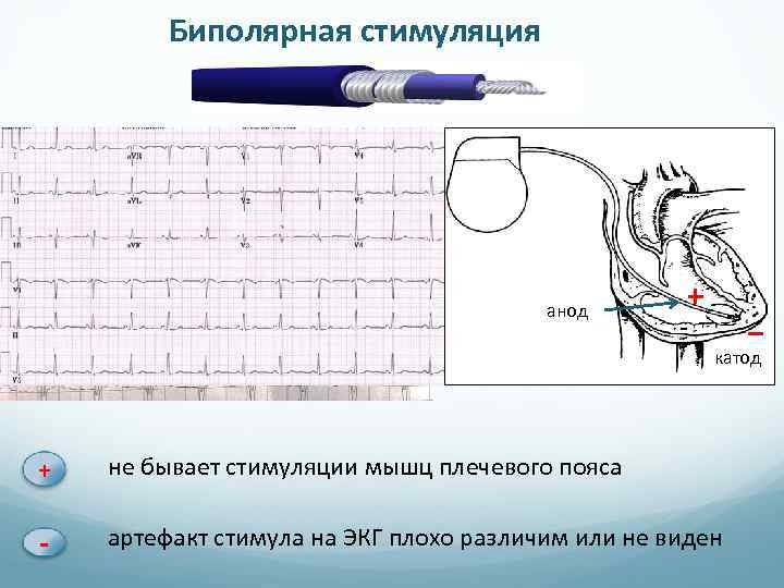 Биполярная стимуляция анод + − катод + не бывает стимуляции мышц плечевого пояса -