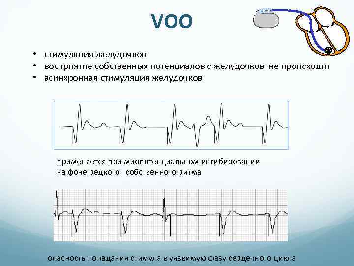 VOO • стимуляция желудочков • восприятие собственных потенциалов с желудочков не происходит • асинхронная