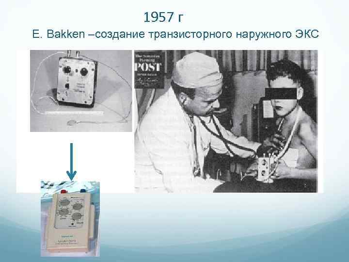 1957 г E. Bakken –создание транзисторного наружного ЭКС 