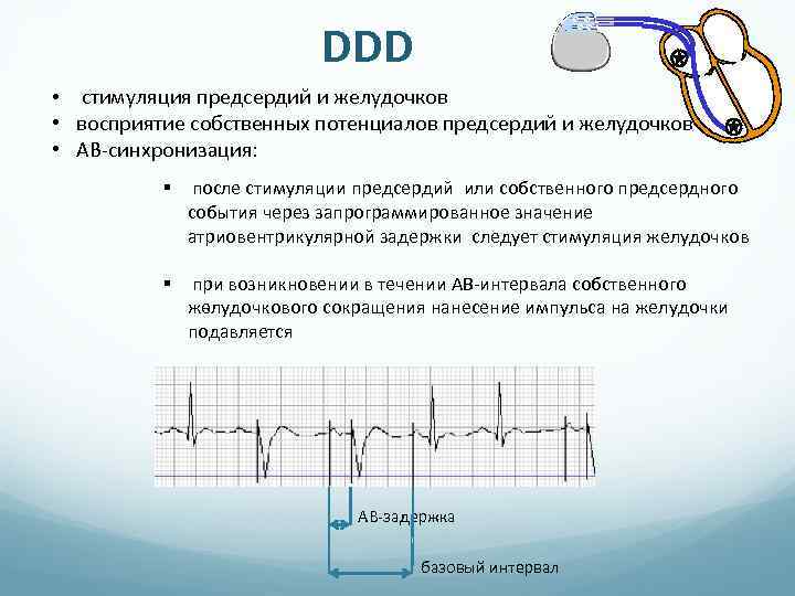 Стимуляция это. Предсердная стимуляция. Стимуляция предсердий и желудочков. Р синхронизированная стимуляция желудочков на ЭКГ. Экс стимуляция желудочков.