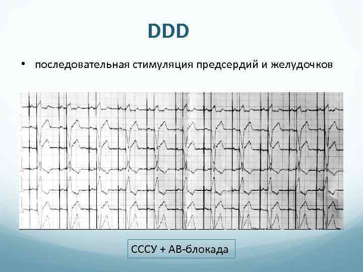 DDD • последовательная стимуляция предсердий и желудочков СССУ + АВ-блокада 