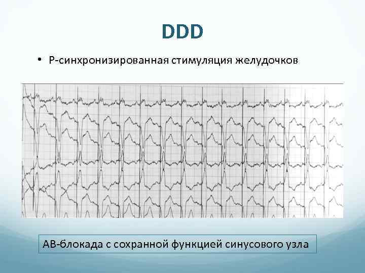 DDD • P-синхронизированная стимуляция желудочков АВ-блокада с сохранной функцией синусового узла 