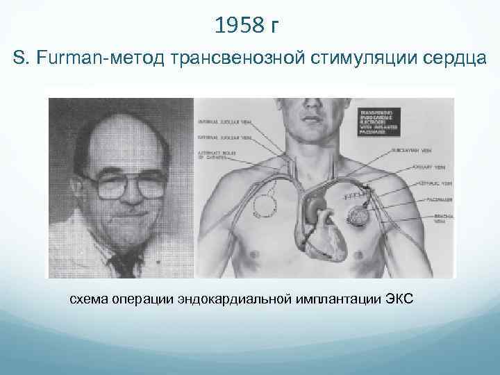 1958 г S. Furman-метод трансвенозной стимуляции сердца схема операции эндокардиальной имплантации ЭКС 