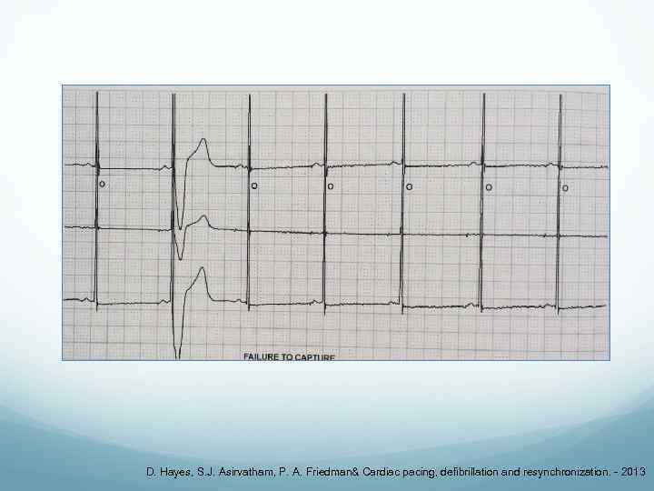 D. Hayes, S. J. Asirvatham, P. A. Friedman& Cardiac pacing, defibrillation and resynchronization. -