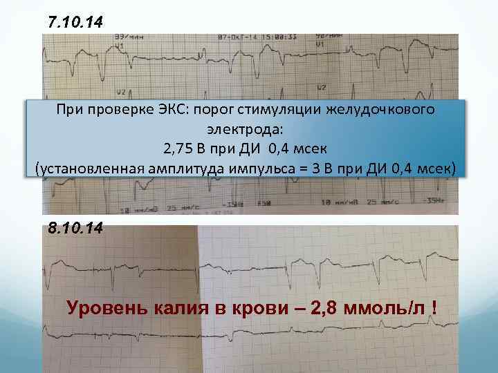 7. 10. 14 При проверке ЭКС: порог стимуляции желудочкового электрода: 2, 75 В при