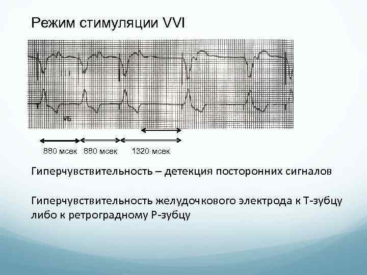 Режим стимуляции VVI 880 мсек 1320 мсек Гиперчувствительность – детекция посторонних сигналов Гиперчувствительность желудочкового