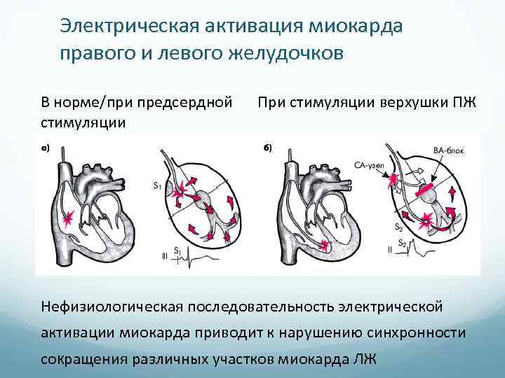 Электрическая активация миокарда правого и левого желудочков В норме/при предсердной стимуляции При стимуляции верхушки