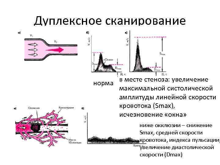 Дуплексное сканирование норма в месте стеноза: увеличение максимальной систолической амплитуды линейной скорости кровотока (Smax),