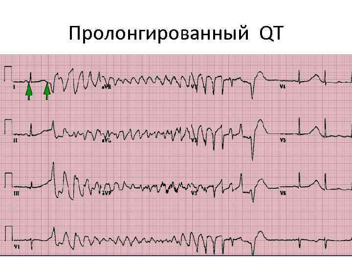 Пролонгированный QT 
