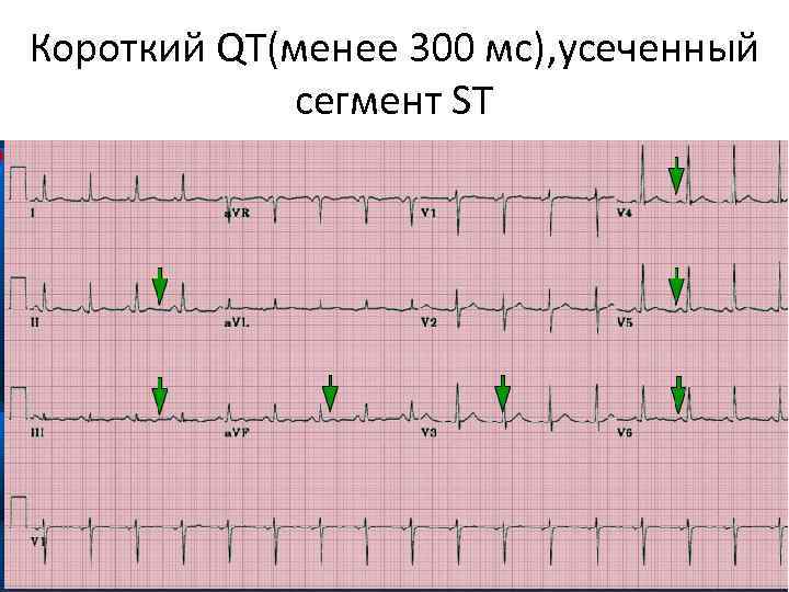 Короткий QT(менее 300 мс), усеченный сегмент ST 
