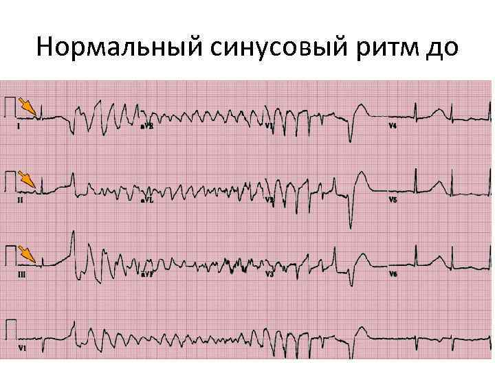 Нормальный синусовый ритм до 