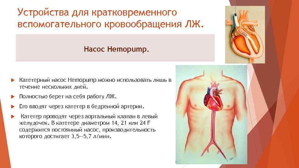 Устройства для кратковременного вспомогательного кровообращения ЛЖ. Насос Hemopump. Катетерный насос Hemopump можно использовать лишь