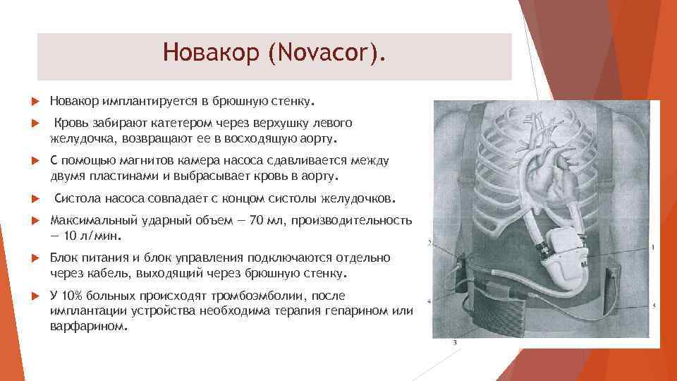 Новакор (Novacor). Новакор имплантируется в брюшную стенку. Кровь забирают катетером через верхушку левого желудочка,