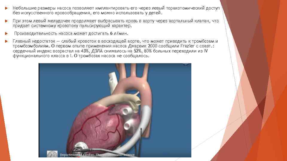  Небольшие размеры насоса позволяют имплантировать его через левый торакотомический доступ без искусственного кровообращения,