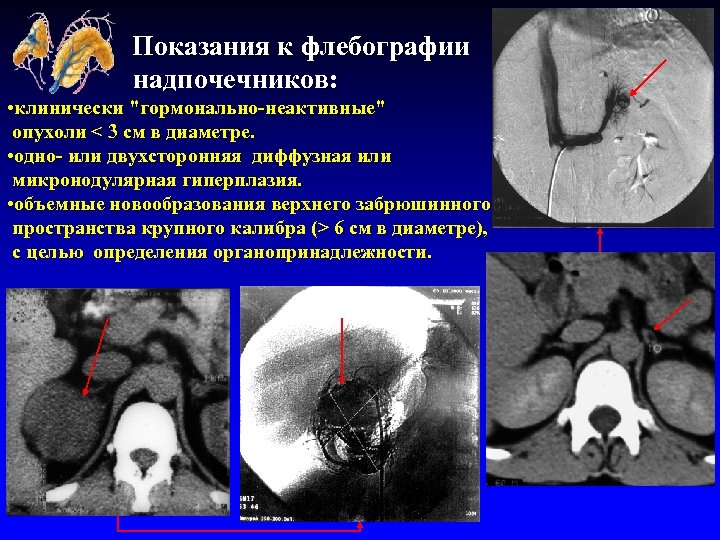 Показания к флебографии надпочечников: • клинически 