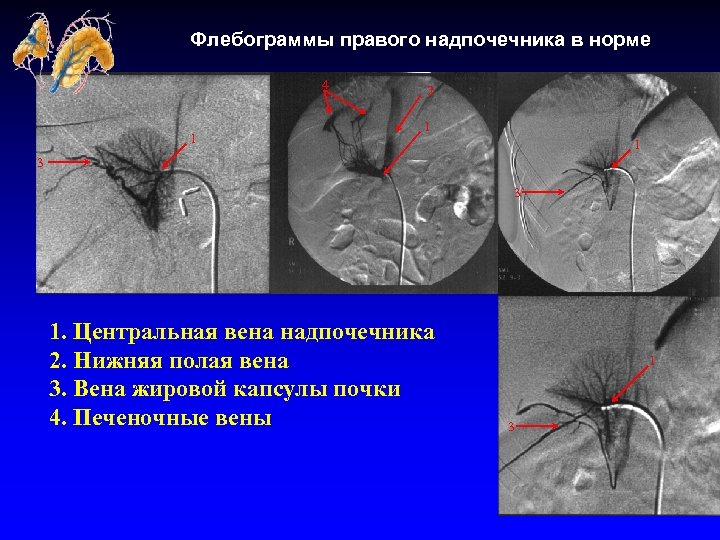 Флебограммы правого надпочечника в норме 4 1 2 1 1 3 3 1. Центральная