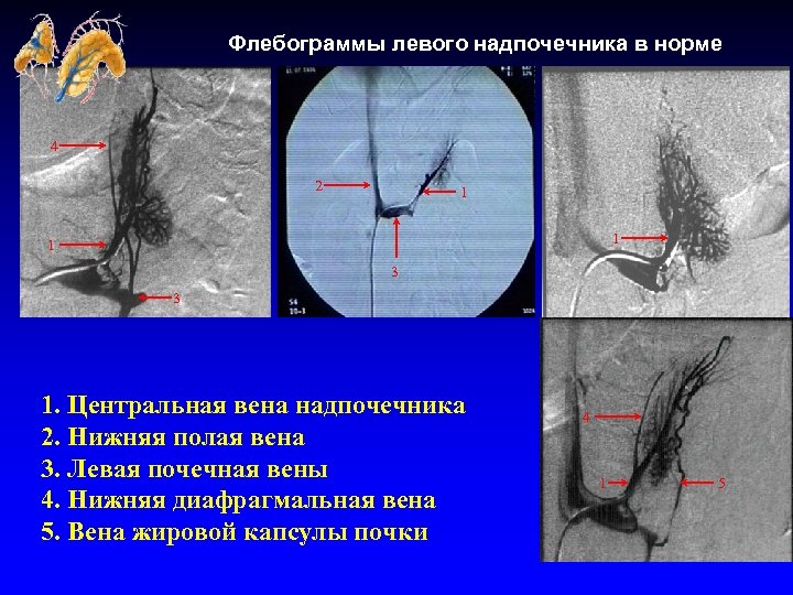 Флебограммы левого надпочечника в норме 4 2 1 1 1 3 3 1. Центральная