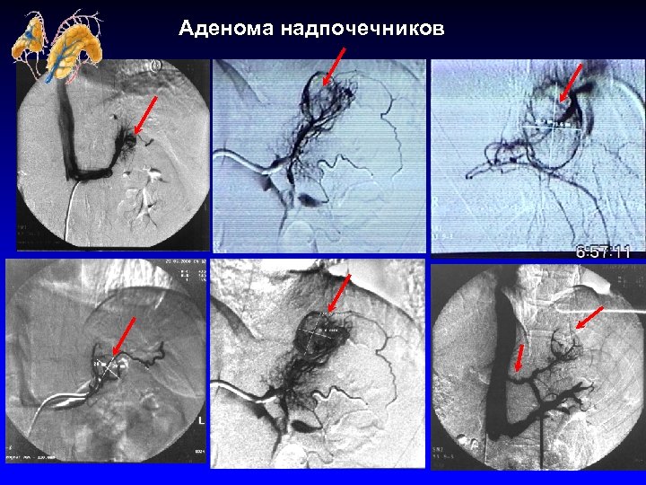 Фото опухоли надпочечника