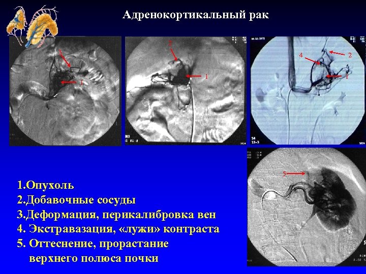 Адренокортикальный рак 2 3 4 1 1 1 5 1. Опухоль 2. Добавочные сосуды