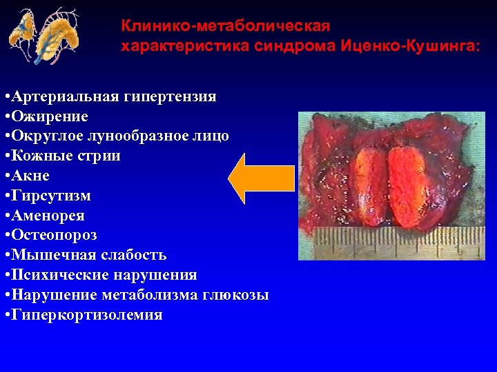 Клинико-метаболическая характеристика синдрома Иценко-Кушинга: • Артериальная гипертензия • Ожирение • Округлое лунообразное лицо •