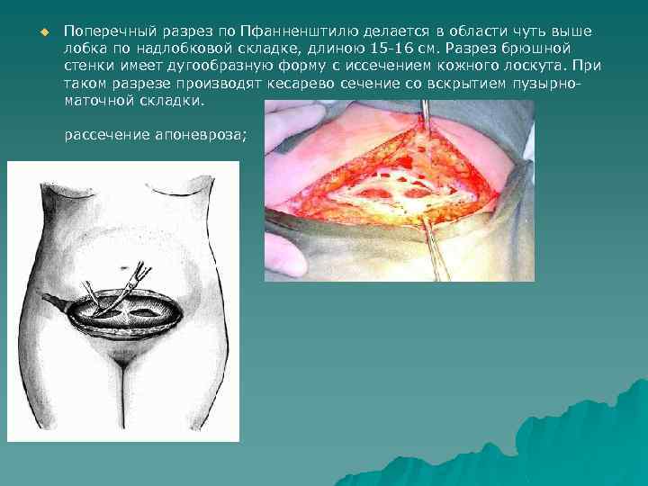 u Поперечный разрез по Пфанненштилю делается в области чуть выше лобка по надлобковой складке,