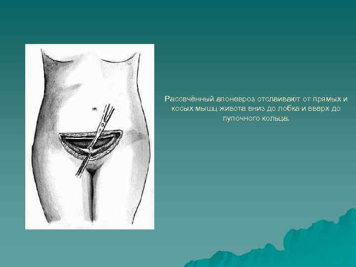 Рассечённый апоневроз отслаивают от прямых и косых мышц живота вниз до лобка и вверх