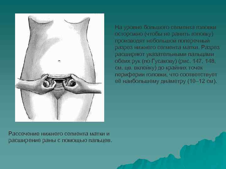 На уровне большого сегмента головки осторожно (чтобы не ранить головку) производят небольшой поперечный разрез